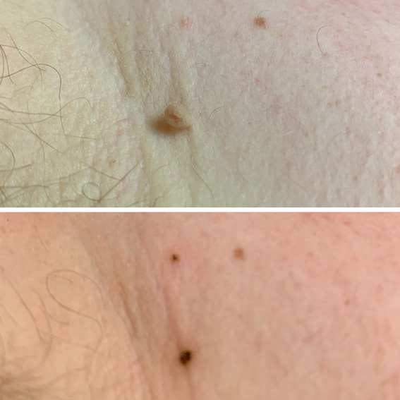 Skin Tag Removal